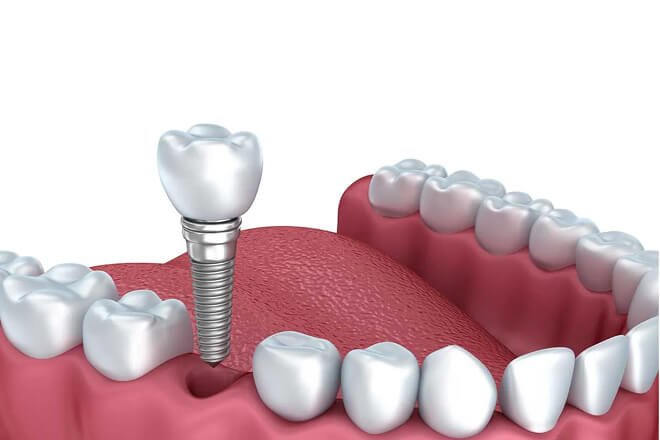 Dental Implants