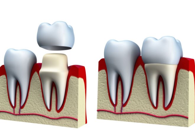 Dental-Crown-Procedure