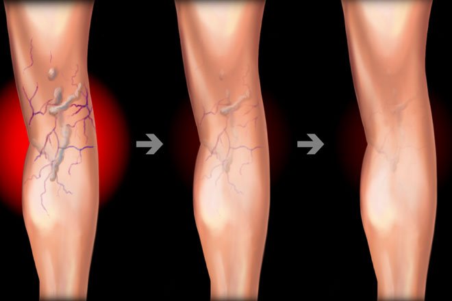 varicose-veins-san-diego