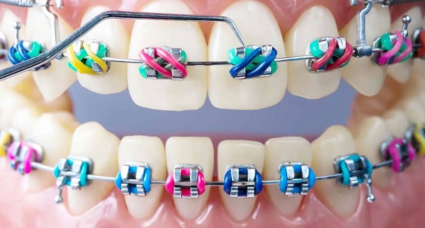 all braces colors