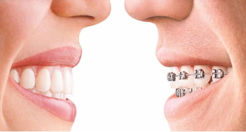 Invisalign orthodontist