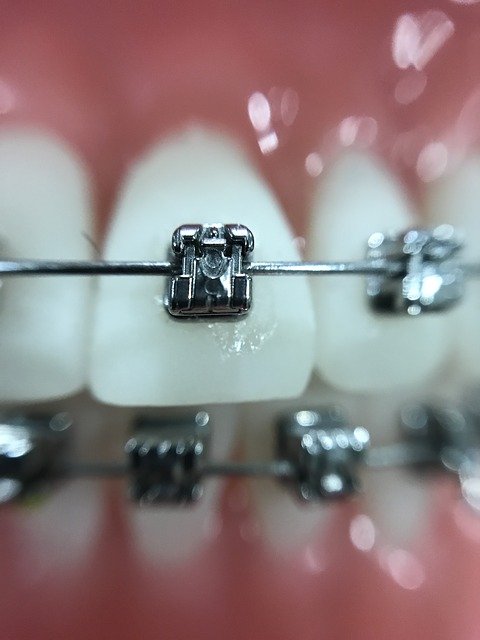 Adult Orthodontics