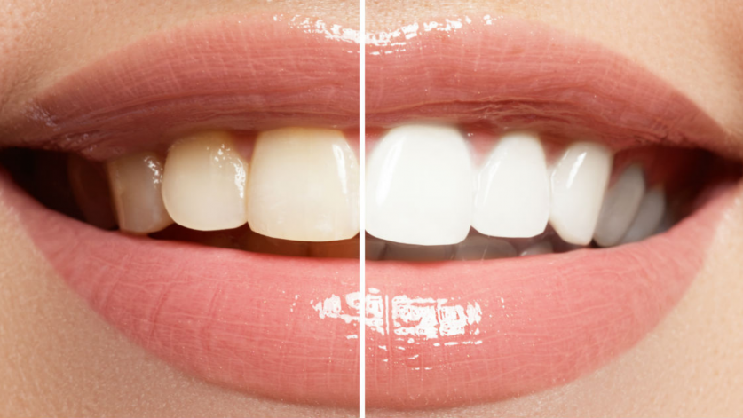 Teeth Whitening