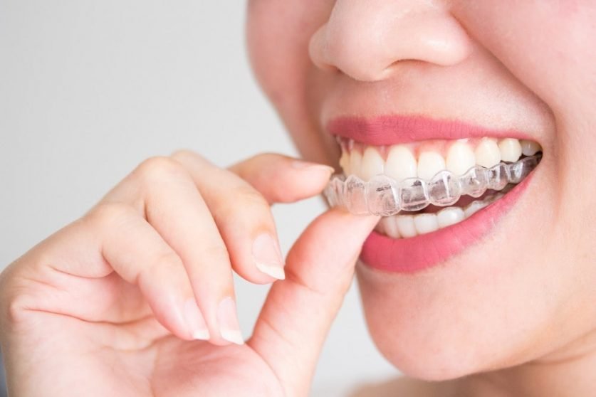 Invisalign attachment