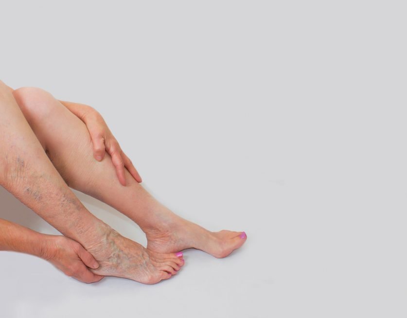 Varicose Veins