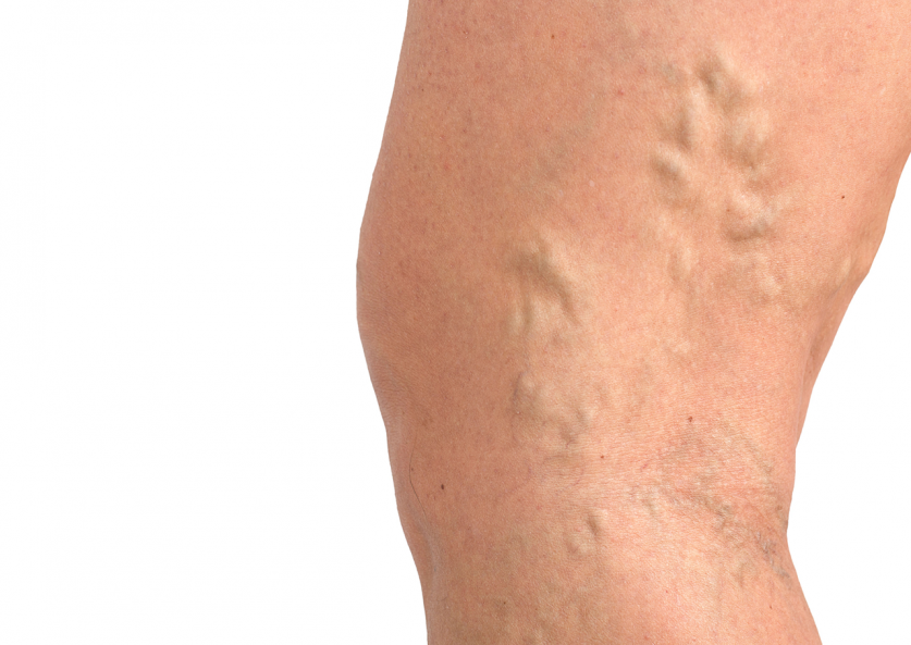 Vein Disease