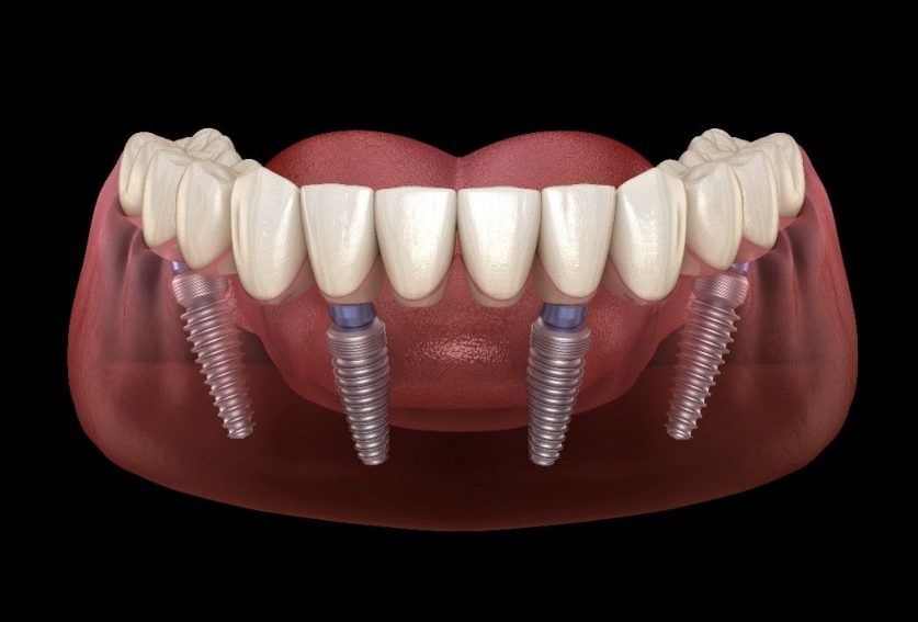 Full Dental Implants