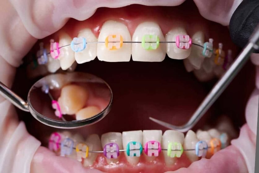 braces colors