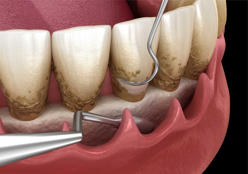 dental deep cleaning