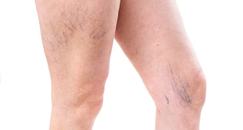 Varicose Veins