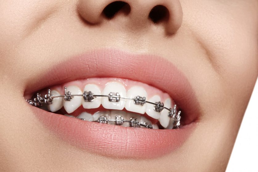 affordable braces