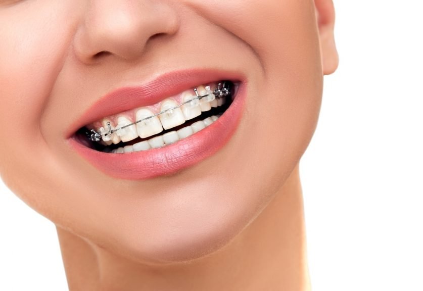 dental braces