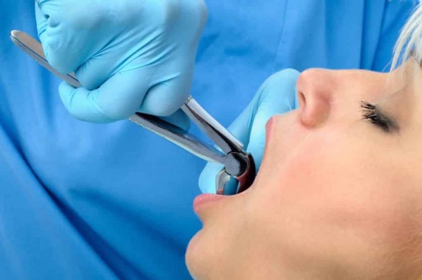 Tooth Extraction