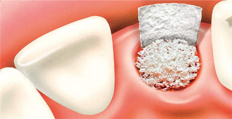 Bone Drafting For Dental Implants