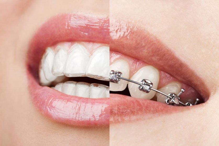 Invisalign or Braces