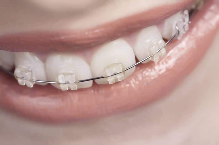 Orthodontic Treatment