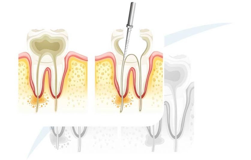 Root Canal Treatment