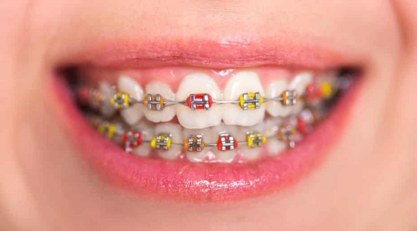 Dental Braces