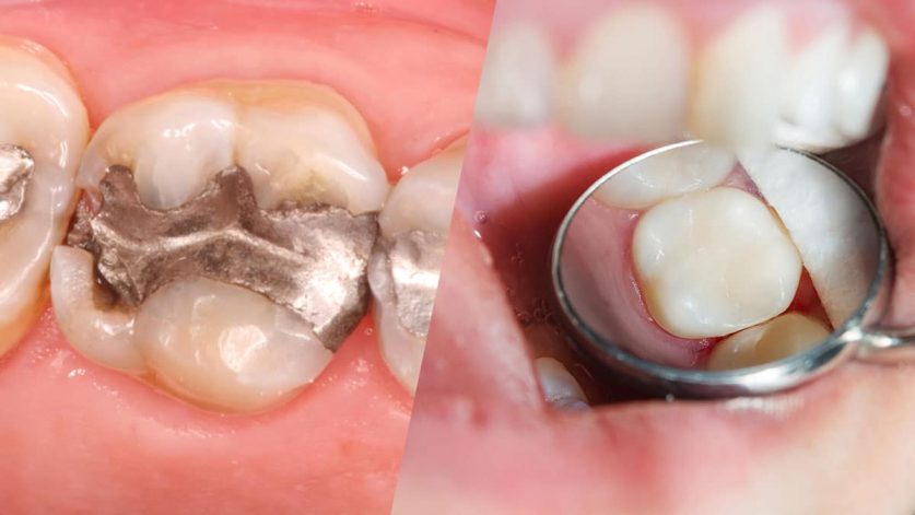 composite dental filling