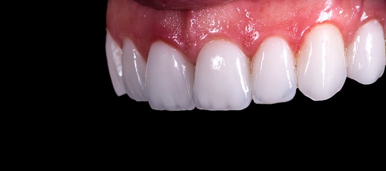 Full Mouth Veneers