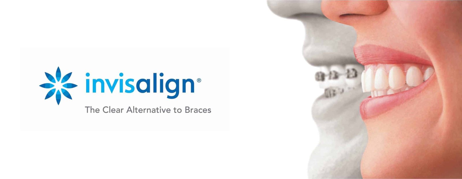 Invisalign