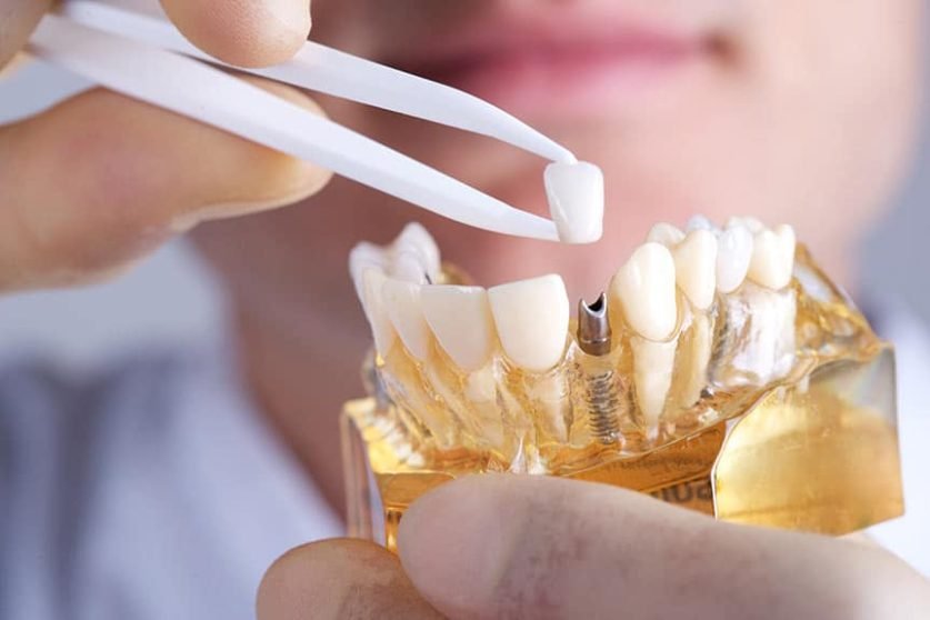 Dental Implant Risks