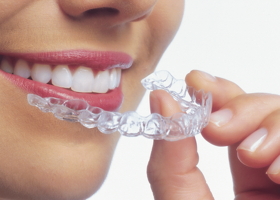 Invisalign aligners