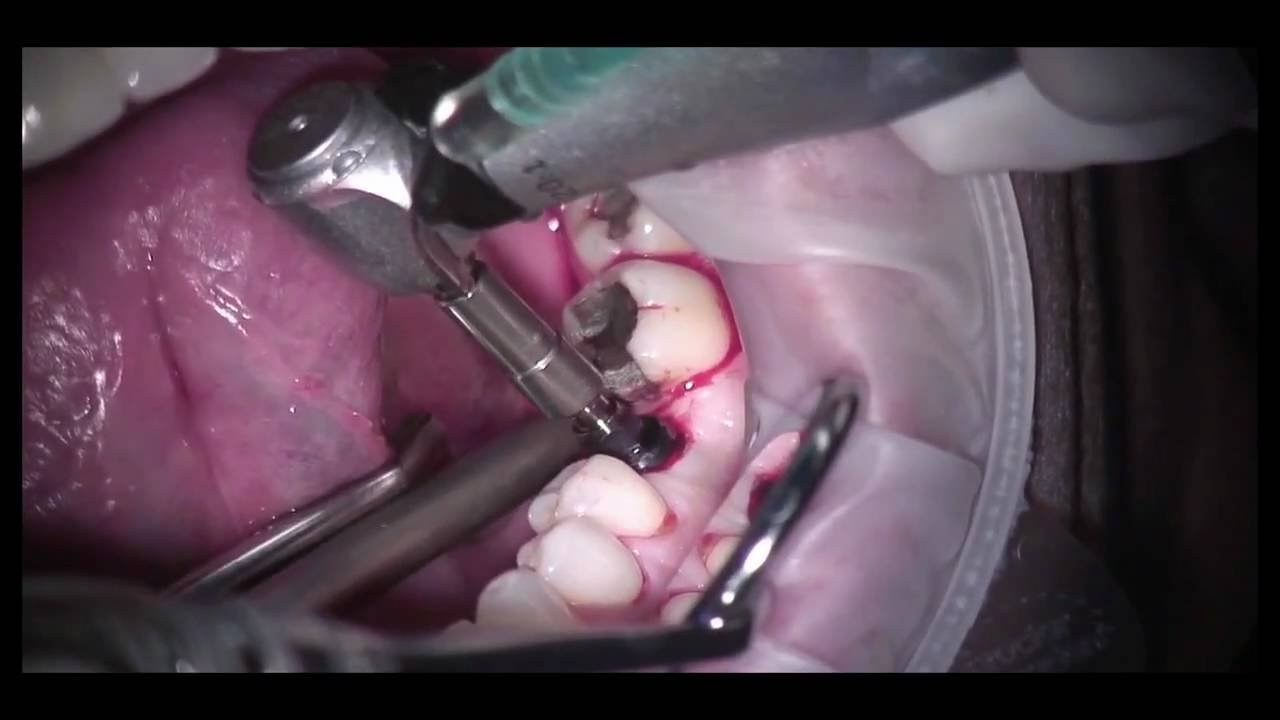 Dental Implants Surgery