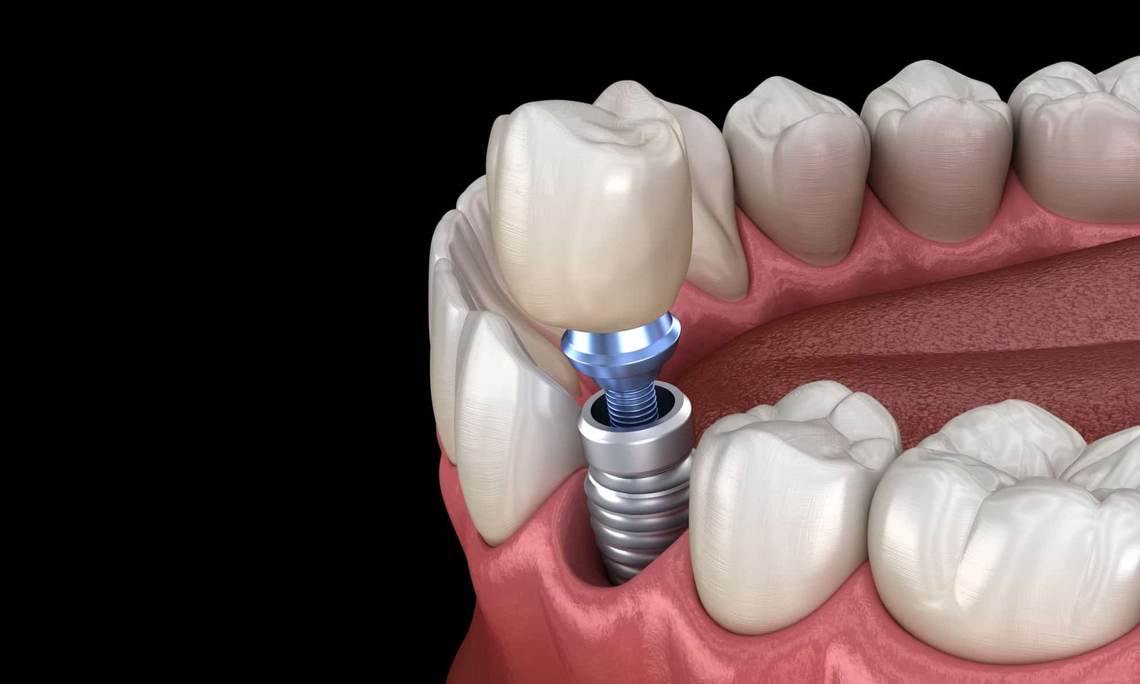 Same Day Dental Implants