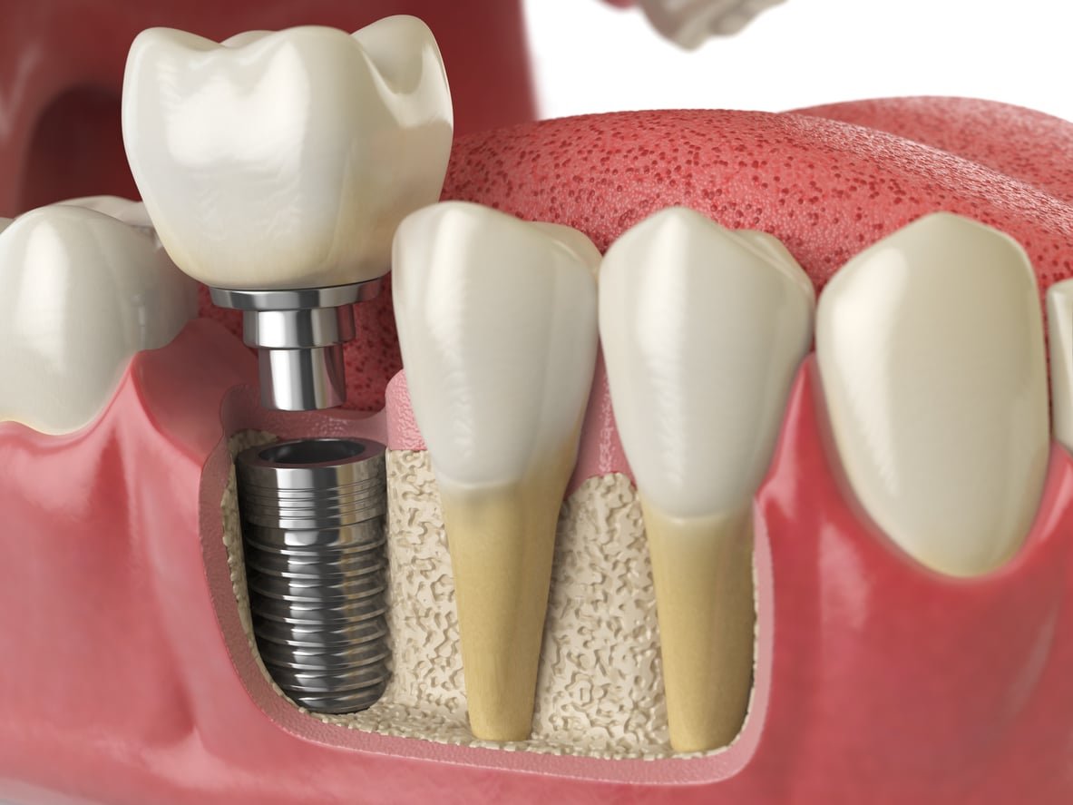 Dental Implants Near Me