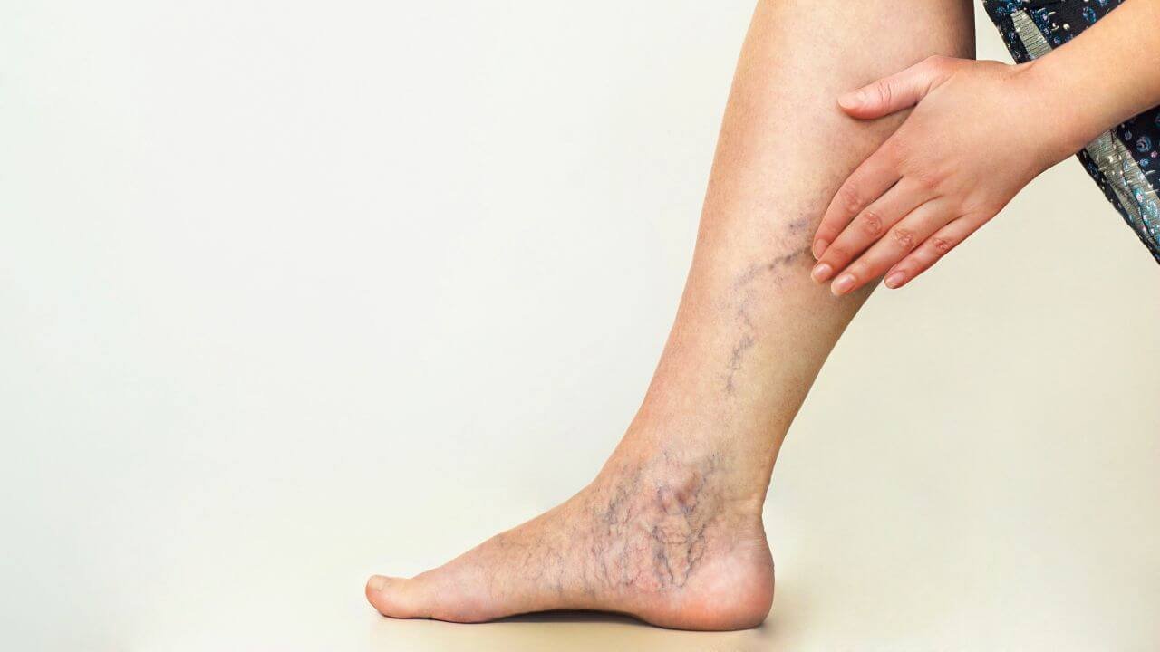 are varicose veins covered by insurance