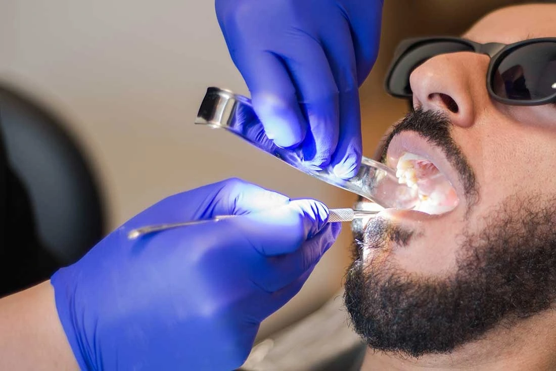 tooth extraction services