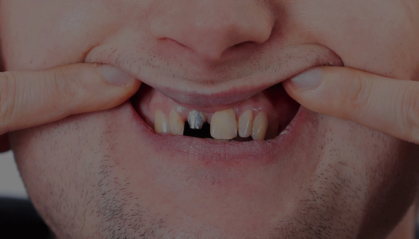 Bone Graft for Dental Implant
