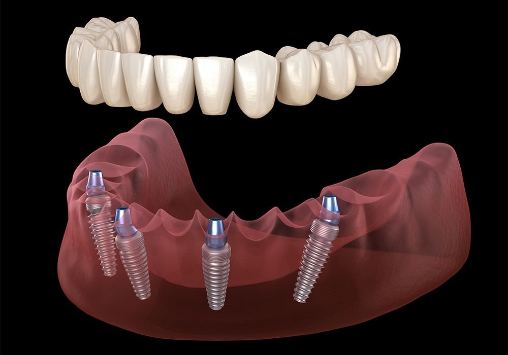 Implant Dentist Houston Tx