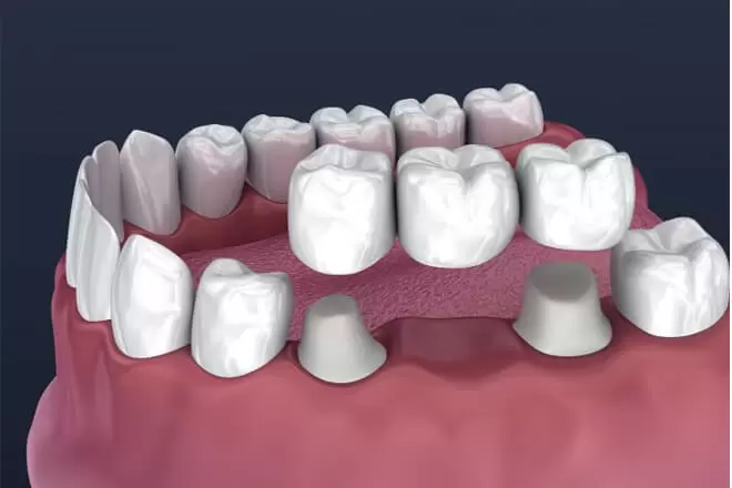 Dental Bridging Process